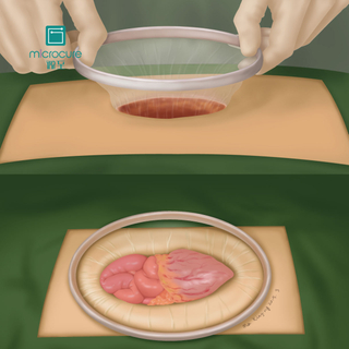 Disposable Protect Incision Silicone Wound Retractor