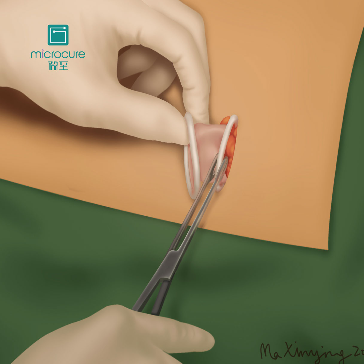 Preventing Bleeding Disposable Incision Sleeve With CE